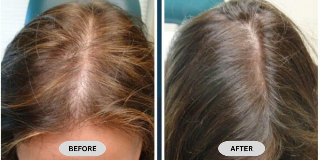 Hair Regrowth Therapy