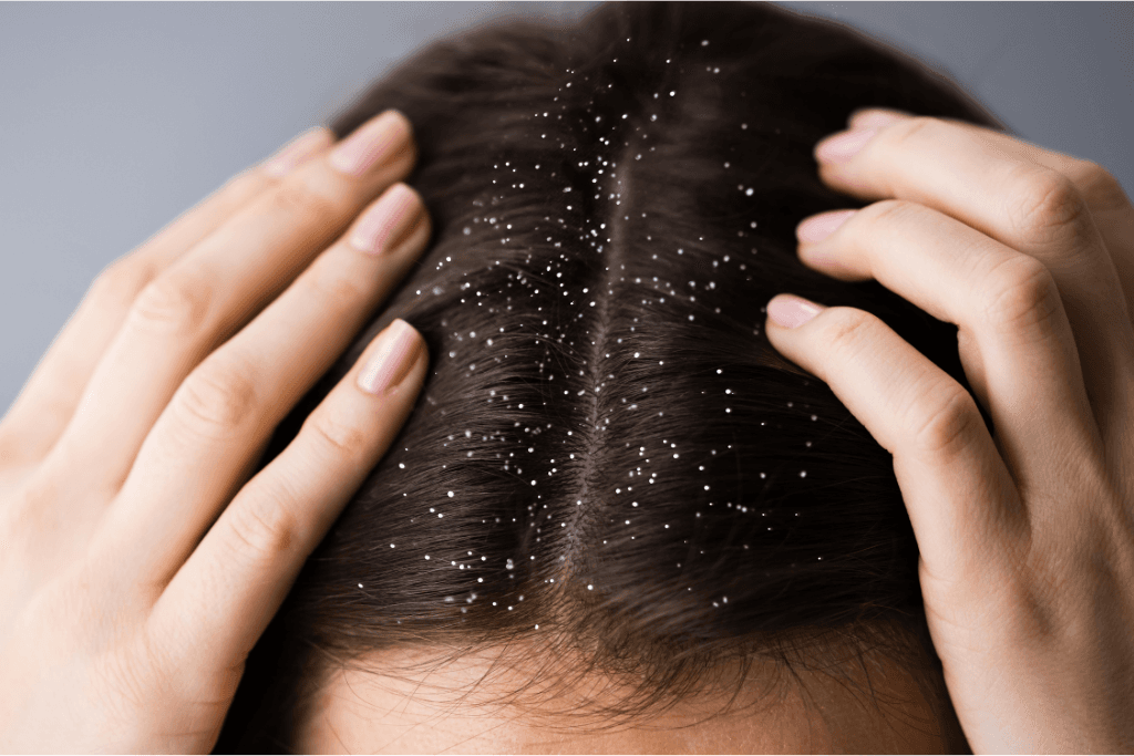Dandruff Treatment for Itchy Scalp
